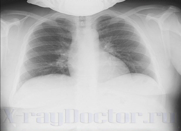 рентгенограмма органов грудной клетки гиперстеника